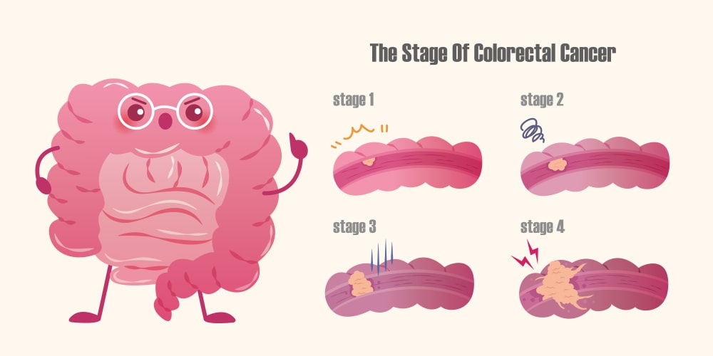 Colon Cancer Stages