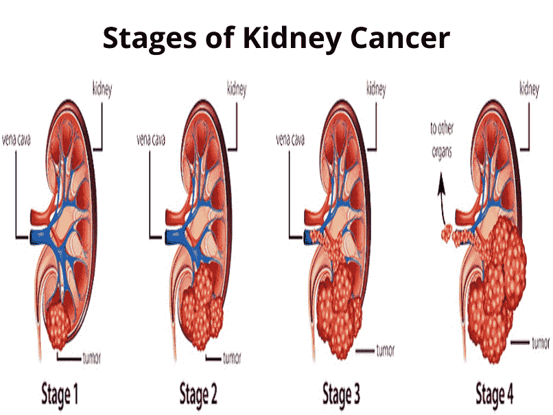 stages of kidney cancer